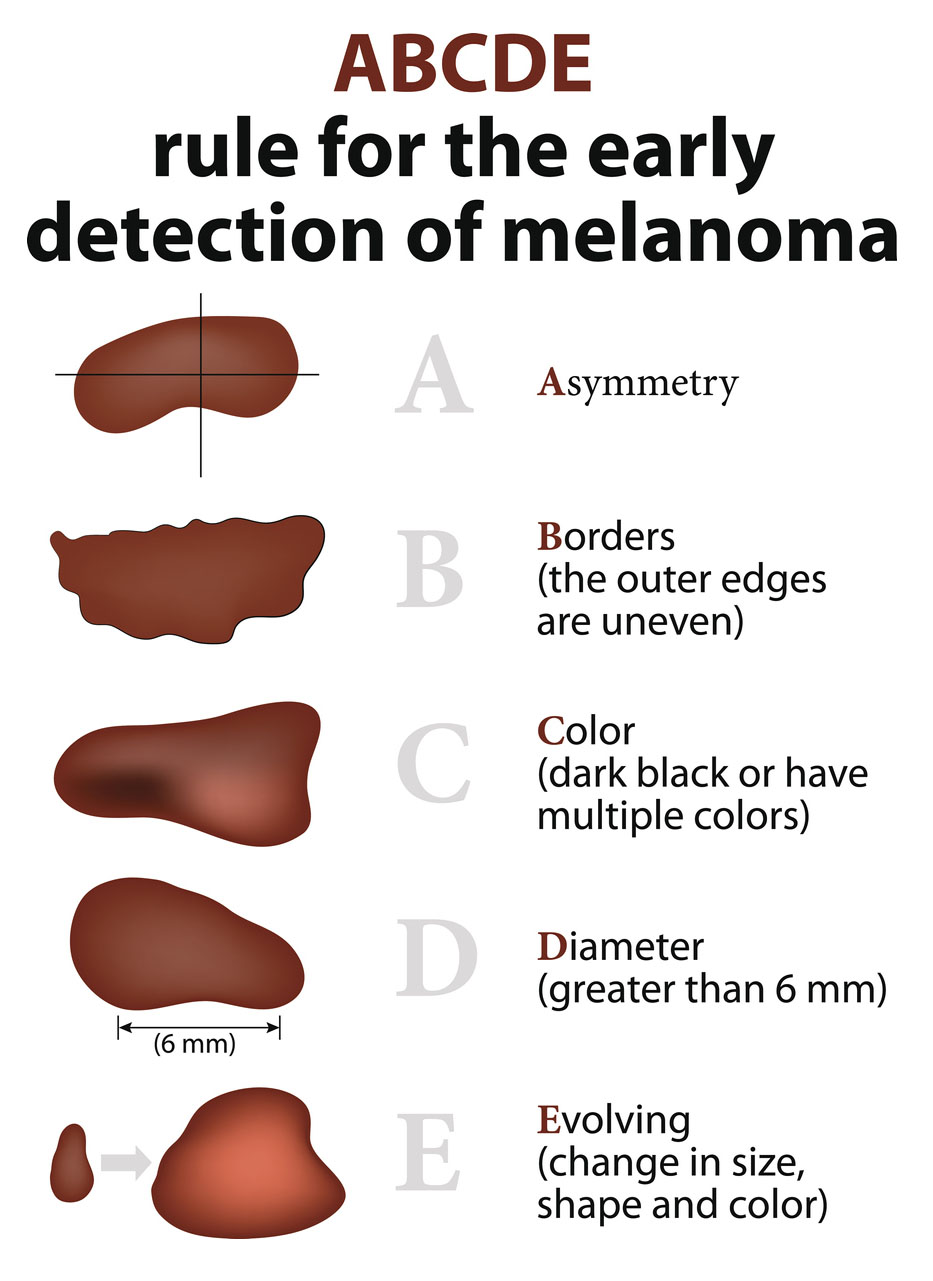Skin cancer infographic